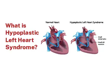 1730695351_What-is-Hypoplastic