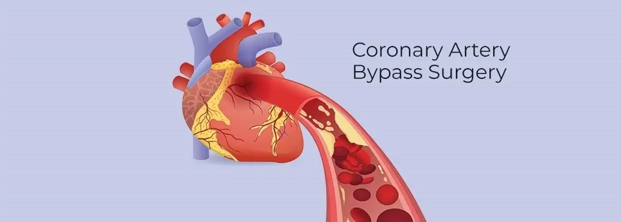 健康・医学 Coronary Artery Bypass Surgery Coronary Artery Bypass Surgery – Health Information Library