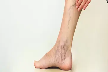 All You Need to Know About Varicose Veins and Your Surgical Options - RBH
