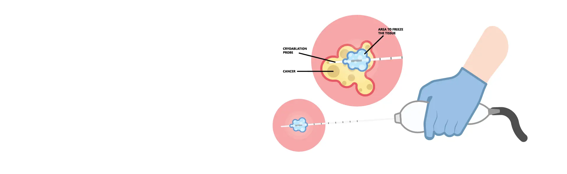 Cryoablation in Kolkata | Advanced Heart Rhythm Treatment